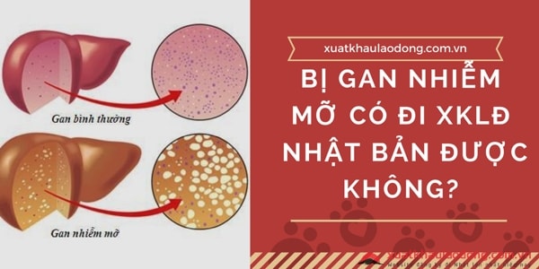 Bị gan nhiễm mỡ có đi xuất khẩu lao động Nhật Bản được không?