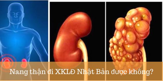 Bị nang thận có đi xuất khẩu lao động Nhật Bản được không?